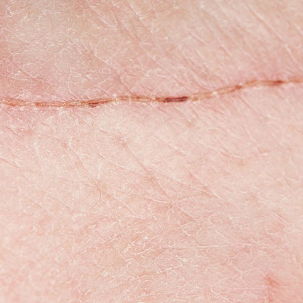 Cicatriz